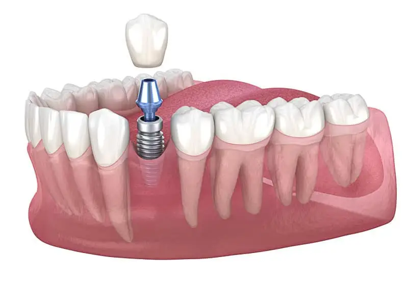 Ayvalı İmplant