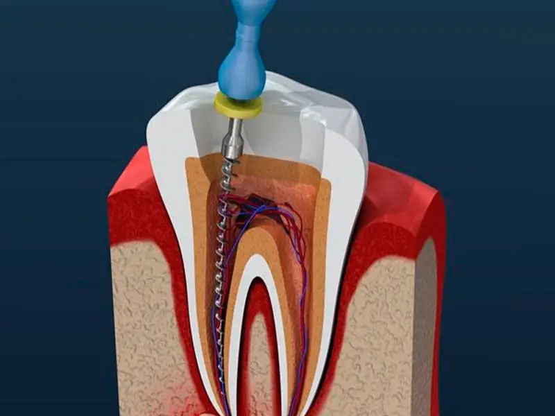 Endodonti Tedavisi Nedir?