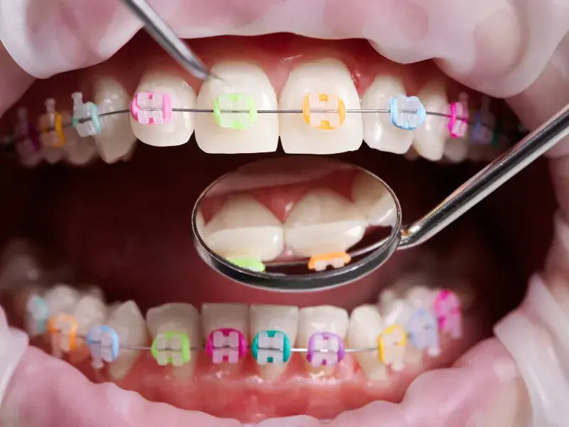 Keçiören Ortodontist