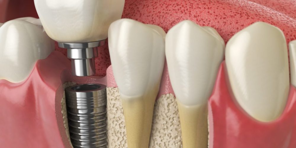 Anatomy of healthy teeth and tooth dental implant in human dentu