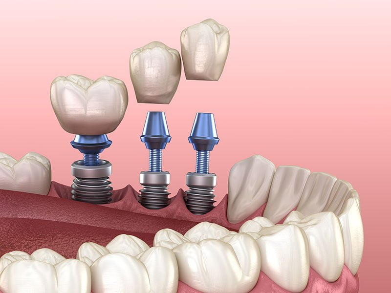 İmplant Tedavisinde Kemik Yapısı Neden Önemlidir?